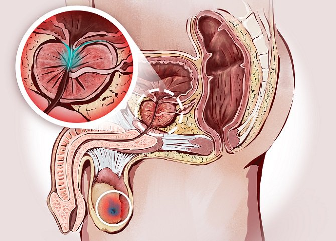 12 Síntomas de cáncer en la próstata que no debemos ignorar.